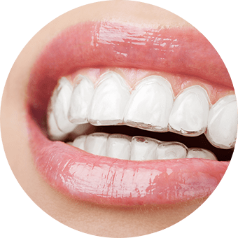 Invisalign