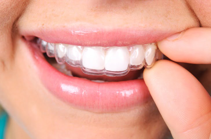 Invisalign