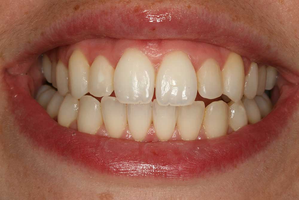 Invisalign