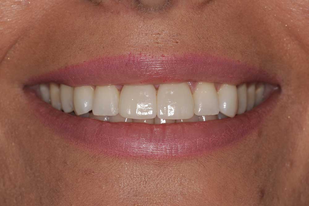 Porcelain Veneers