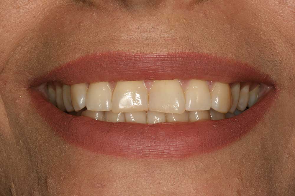 Porcelain Veneers