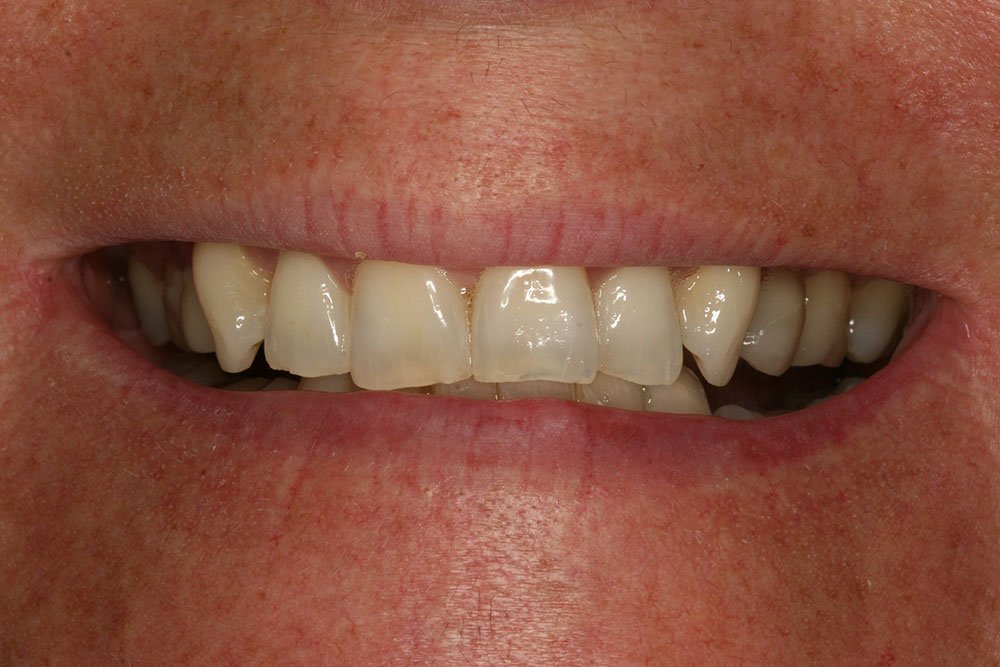 Patient Gallery &#8211; Composite Bonding