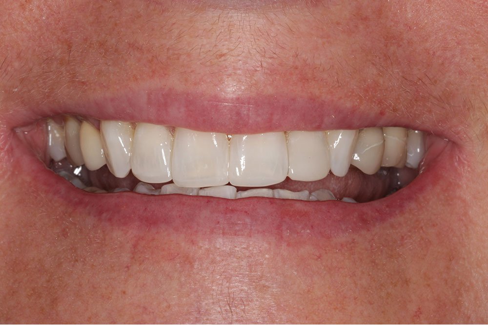 Patient Gallery &#8211; Composite Bonding