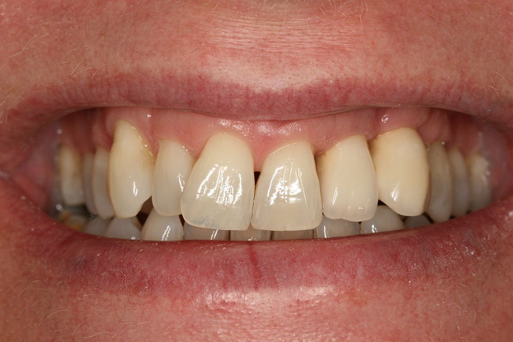 Patient Gallery &#8211; Dental Implants