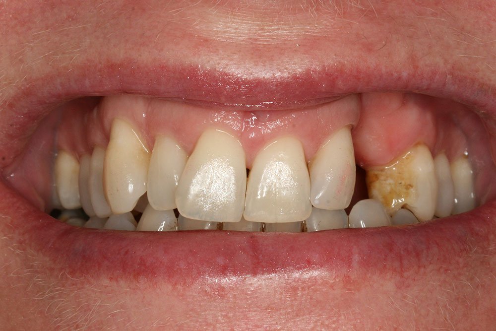 Patient Gallery &#8211; Dental Implants