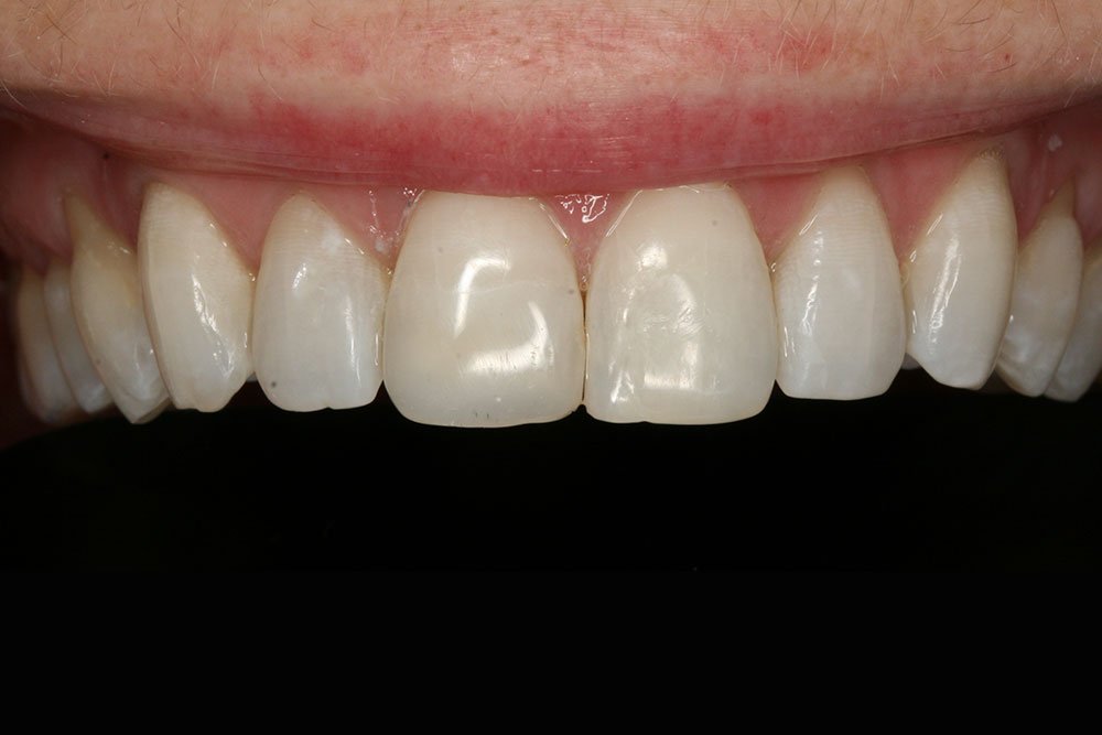 Patient Gallery &#8211; Composite Bonding