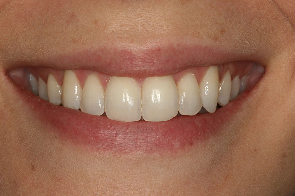 Patient Gallery &#8211; Invisalign