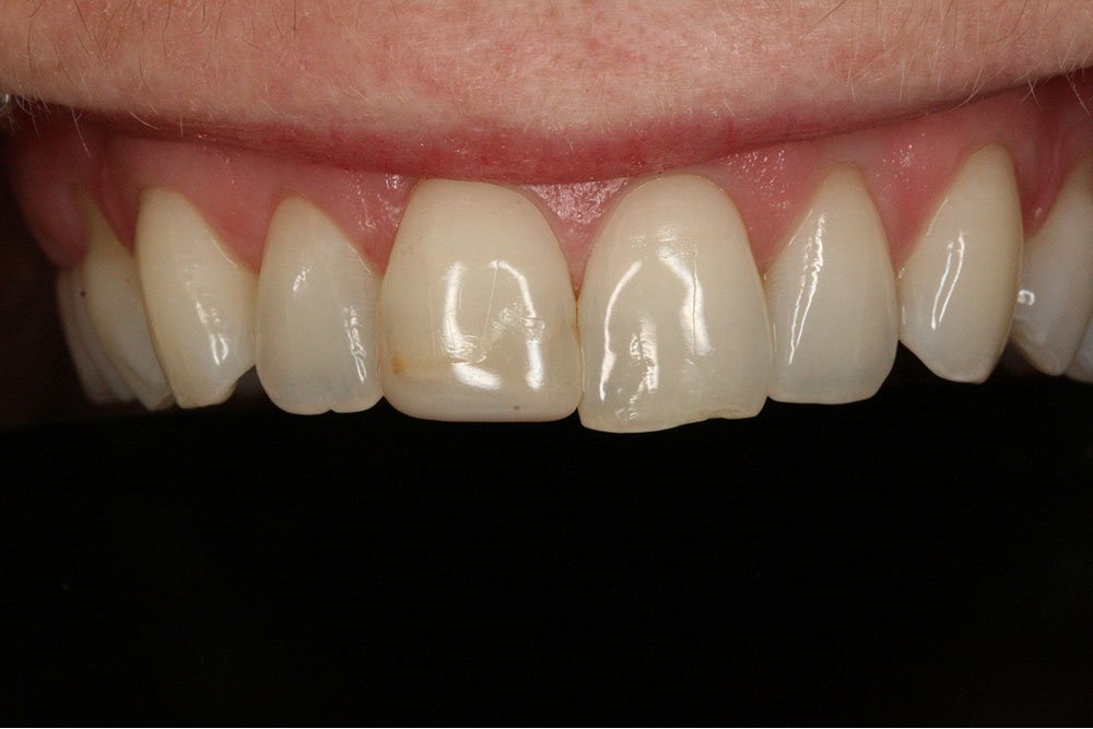 Patient Gallery &#8211; Composite Bonding