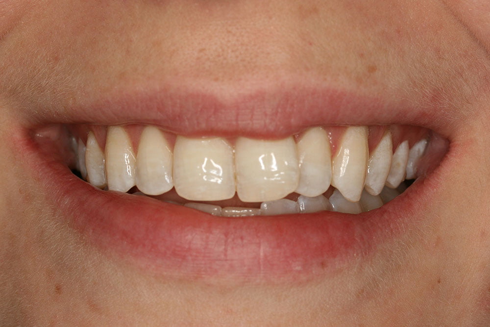 Patient Gallery &#8211; Invisalign