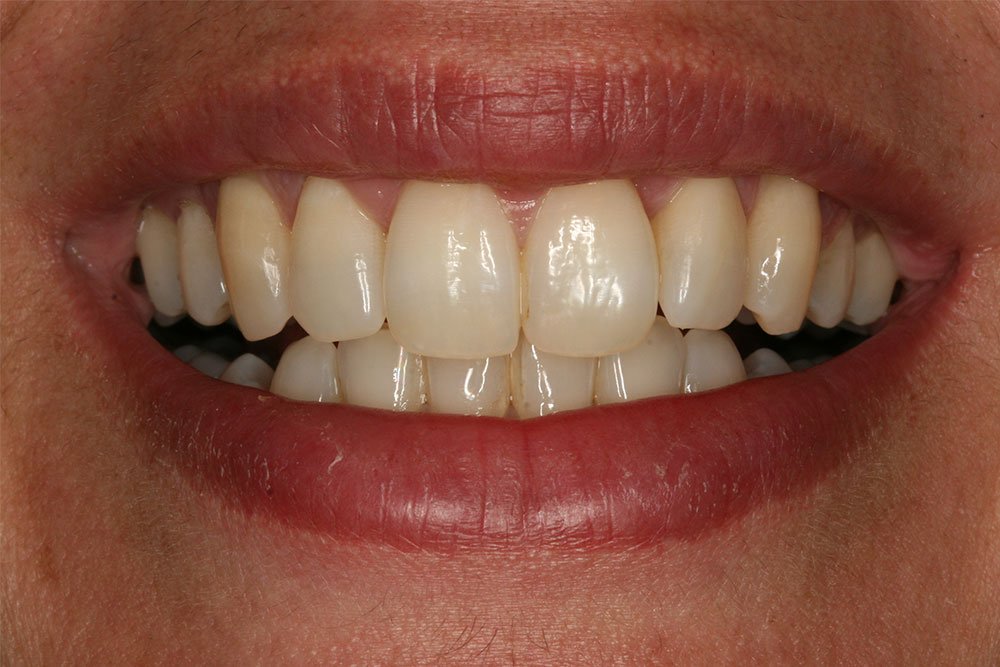 Patient Gallery &#8211; Invisalign