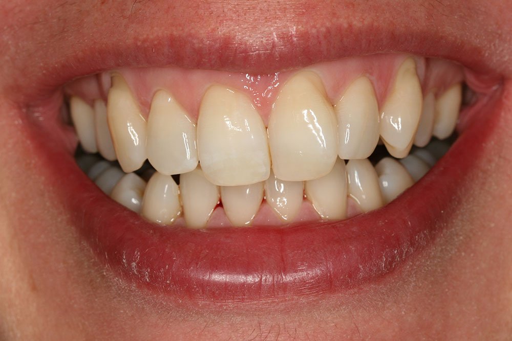 Patient Gallery &#8211; Invisalign