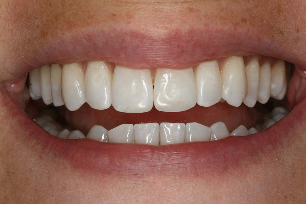 Patient Gallery &#8211; Composite Bonding