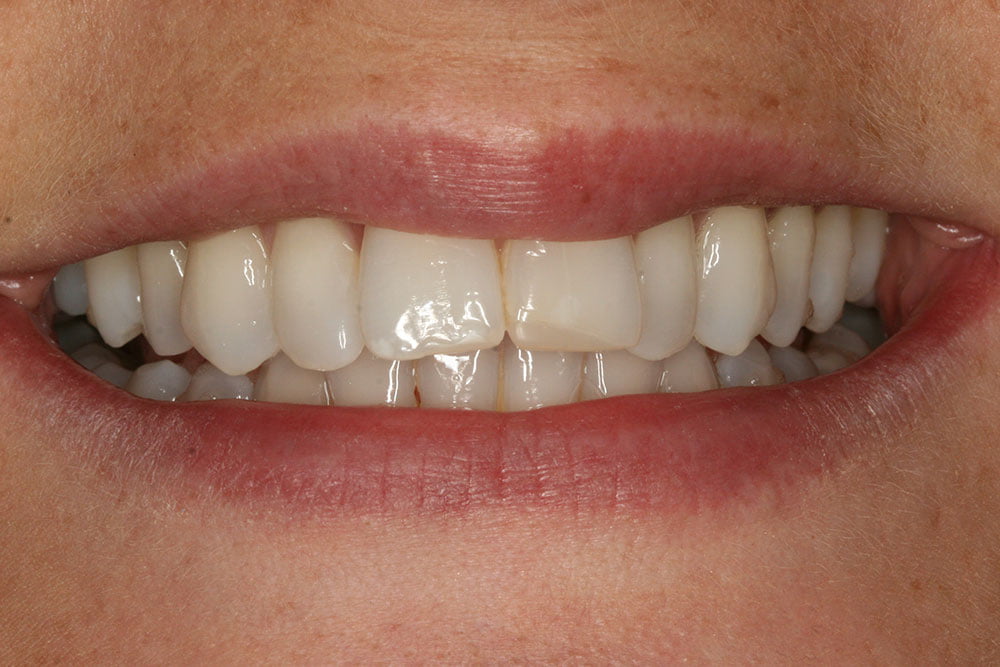 Patient Gallery &#8211; Composite Bonding