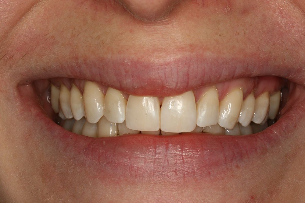 Patient Gallery &#8211; Composite Bonding