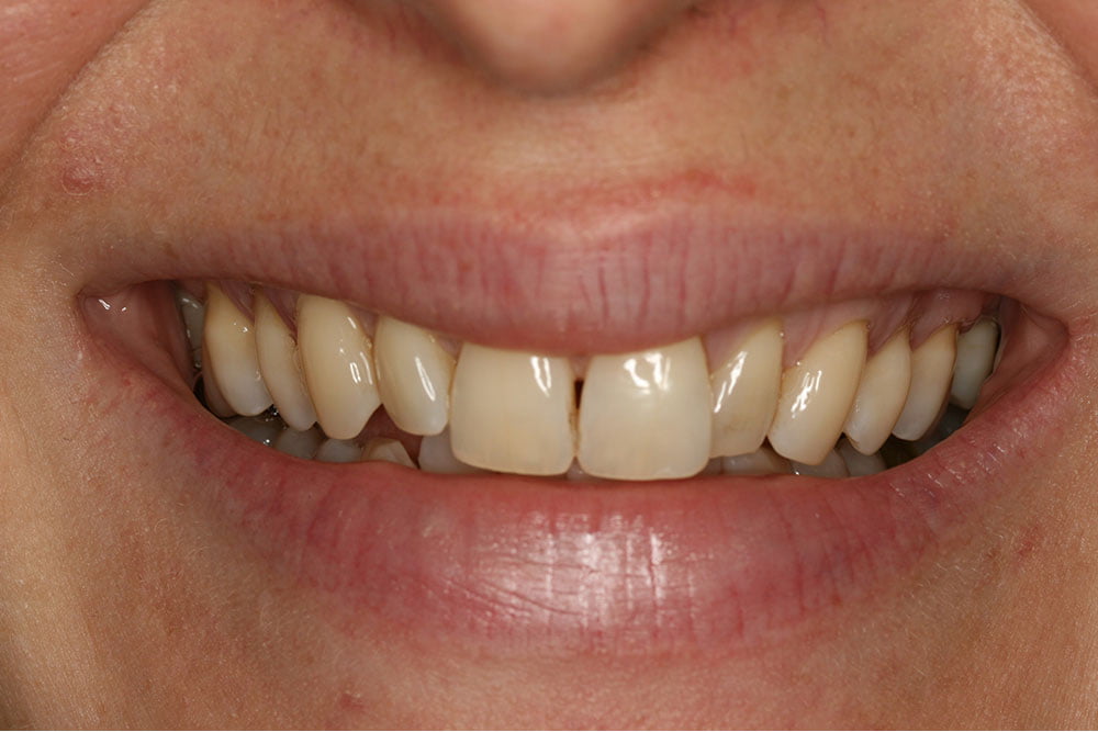 Patient Gallery &#8211; Composite Bonding