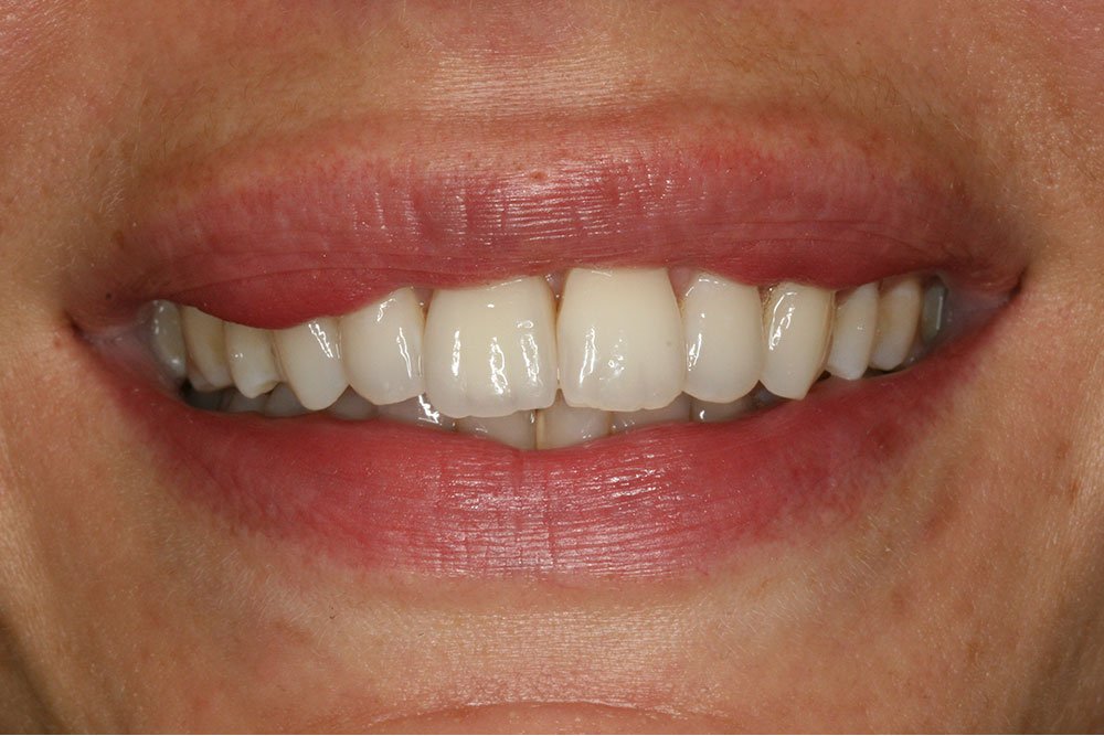 Patient Gallery &#8211; Dental Implants