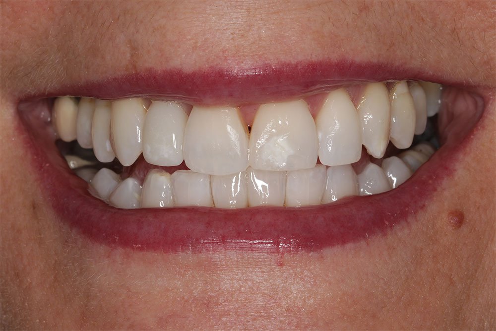 Patient Gallery &#8211; Invisalign