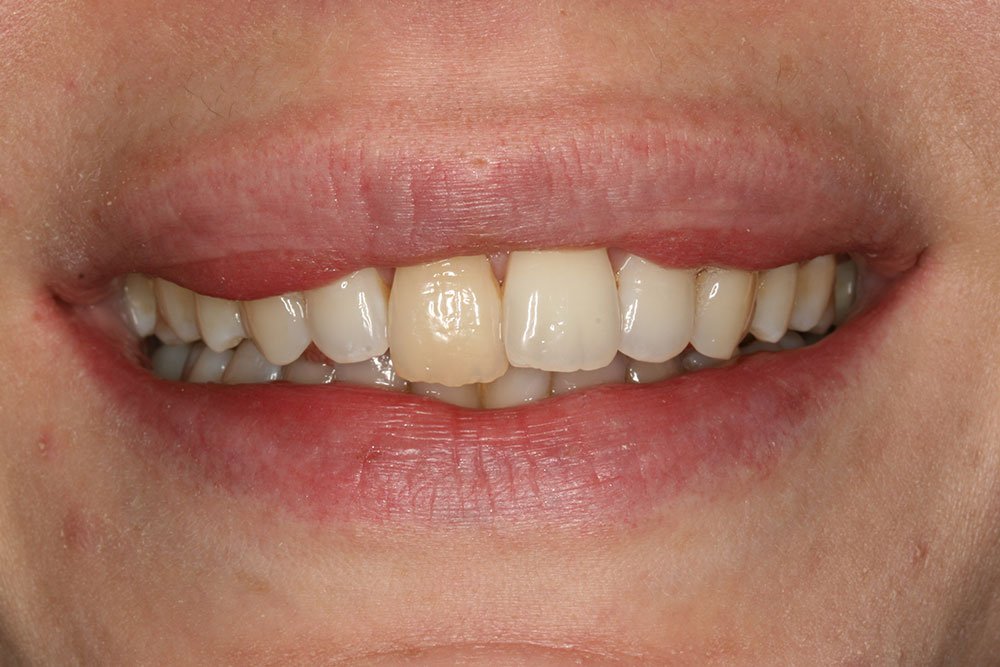 Patient Gallery &#8211; Dental Implants