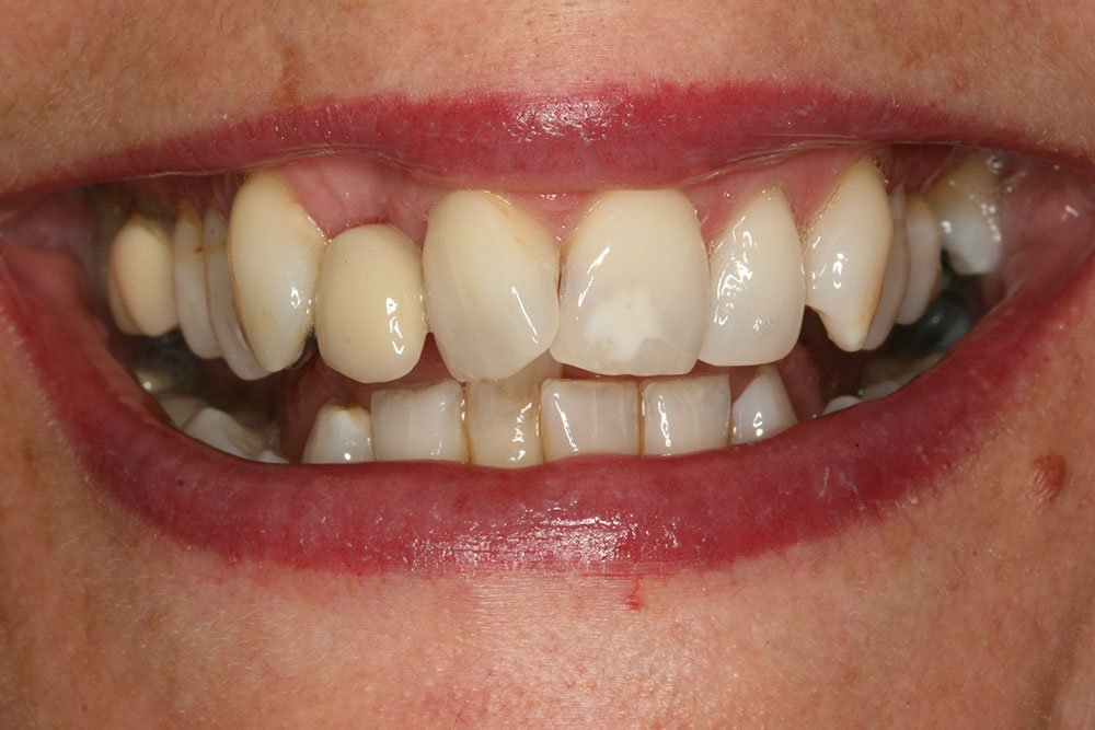 Patient Gallery &#8211; Invisalign