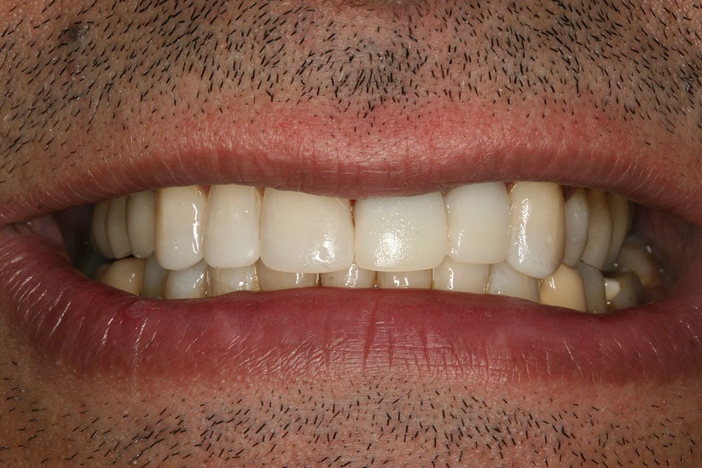 Patient Gallery &#8211; Composite Bonding