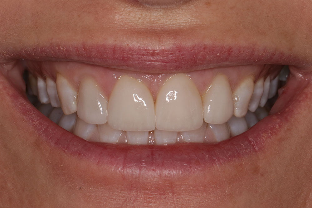 Crooked teeth veneers before and after