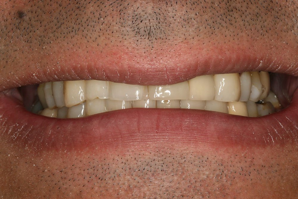 Patient Gallery &#8211; Composite Bonding