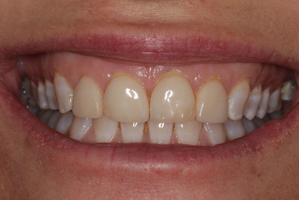 Crooked teeth veneers before and after