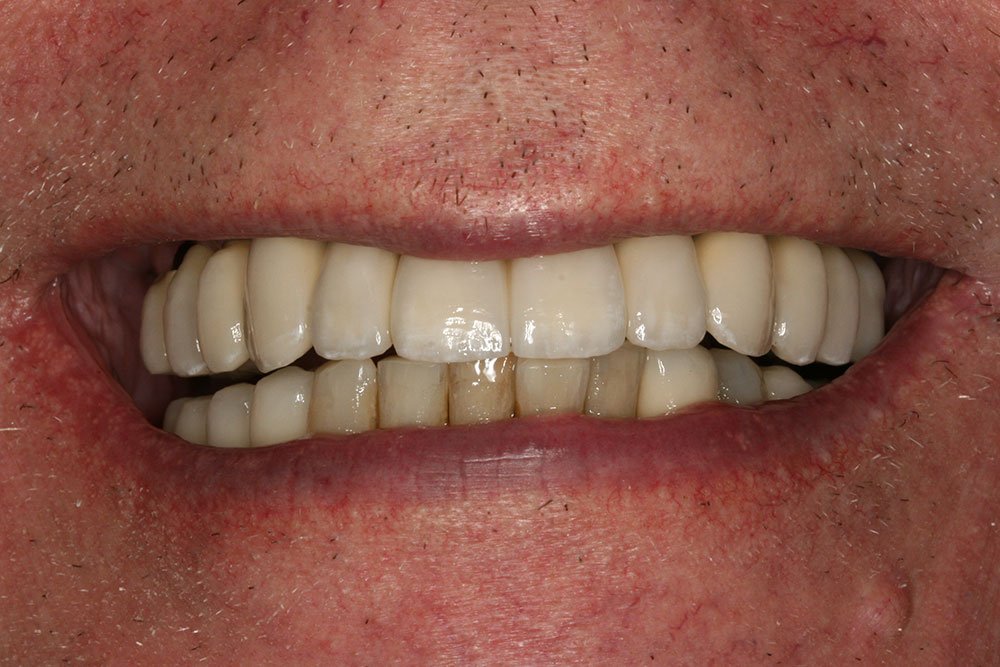 Patient Gallery &#8211; Dental Implants