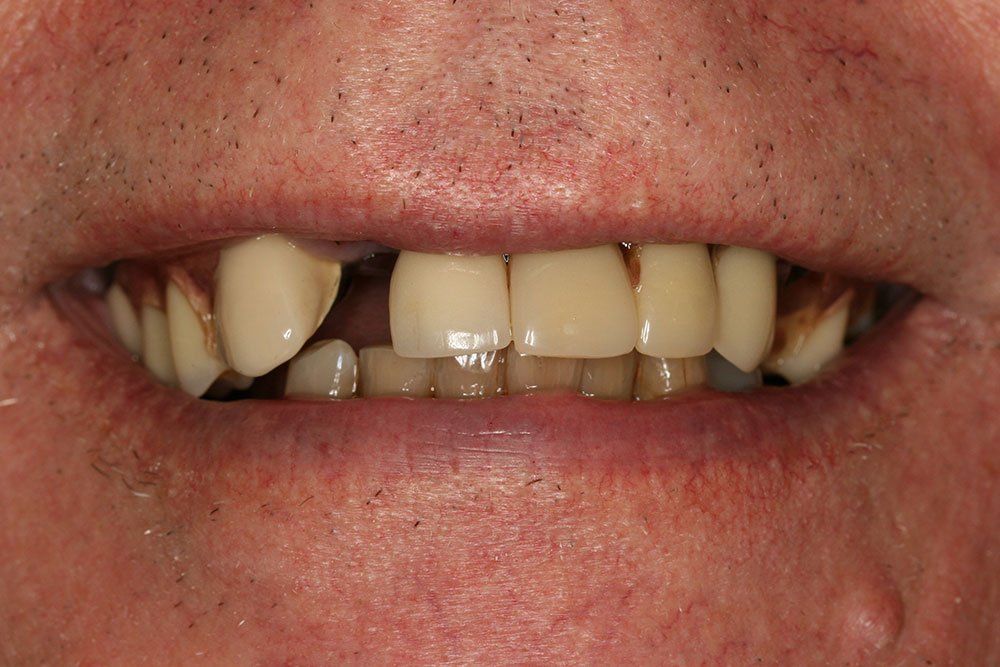 Patient Gallery &#8211; Dental Implants