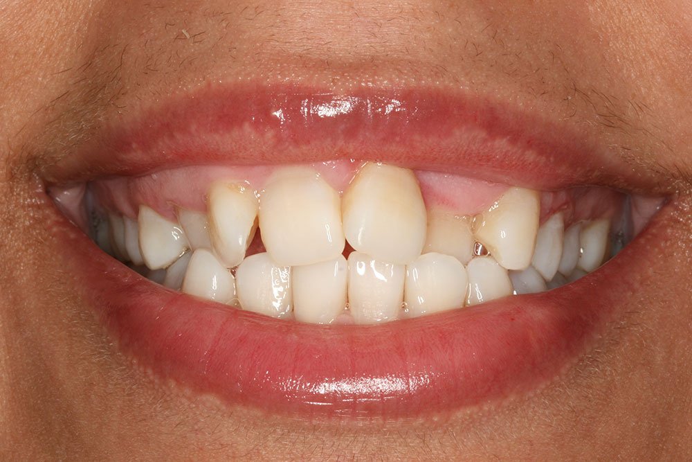 Patient Gallery &#8211; Invisalign