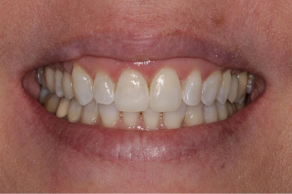 Benefits of Composite Bonding or White Filling - London Specialist Dentists