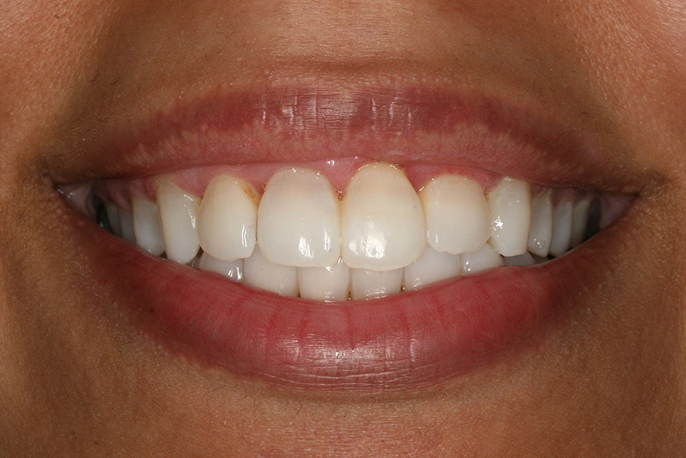 Patient Gallery &#8211; Invisalign