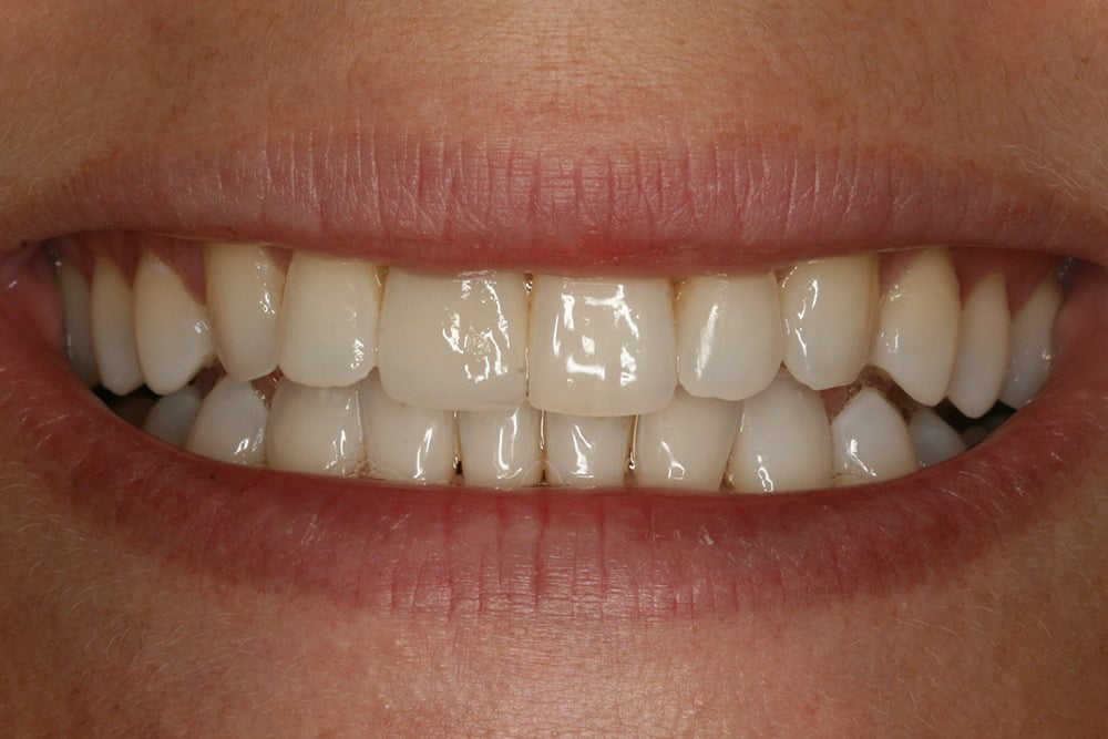 Crooked teeth veneers before and after