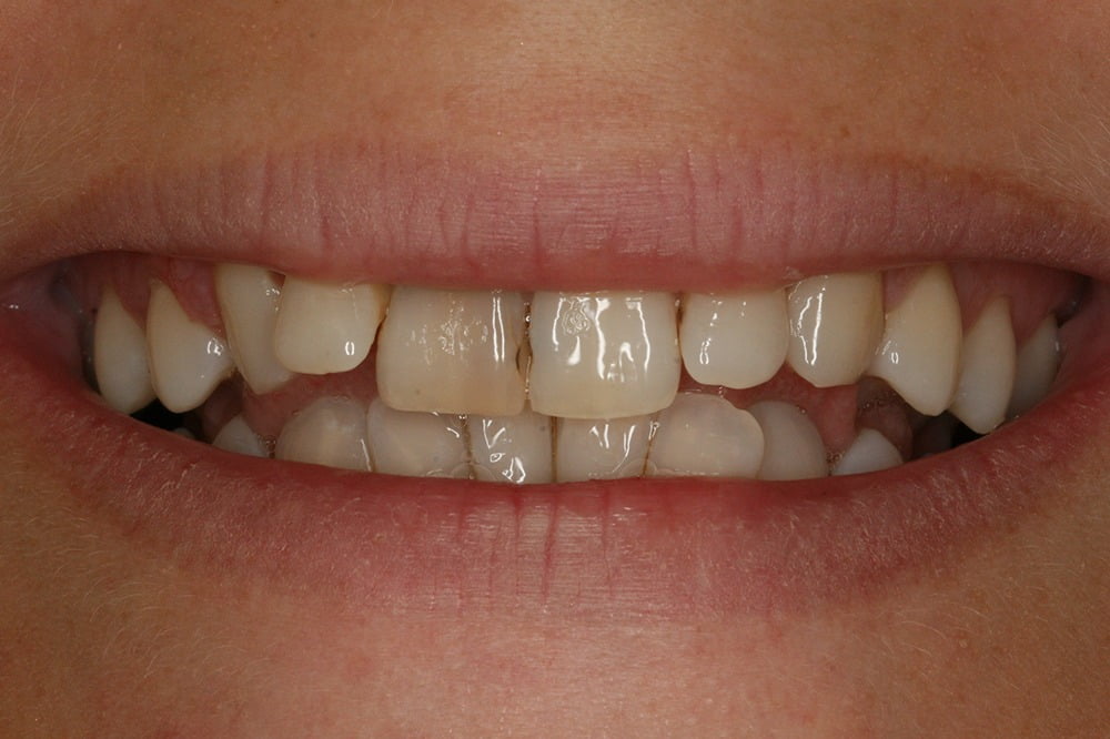 Crooked teeth veneers before and after