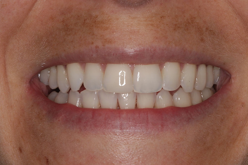 Patient Gallery &#8211; Composite Bonding