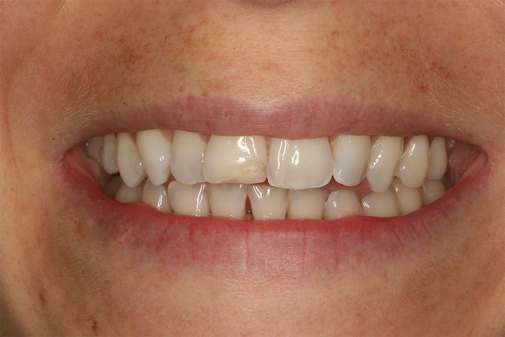 Patient Gallery &#8211; Composite Bonding