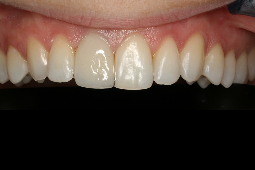 Crooked teeth veneers before and after