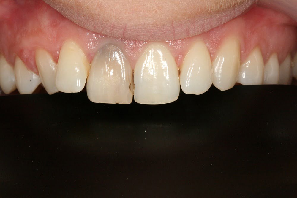 Crooked teeth veneers before and after