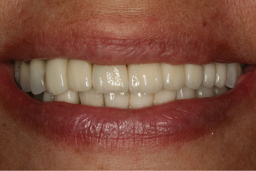 Patient Gallery &#8211; Dental Implants