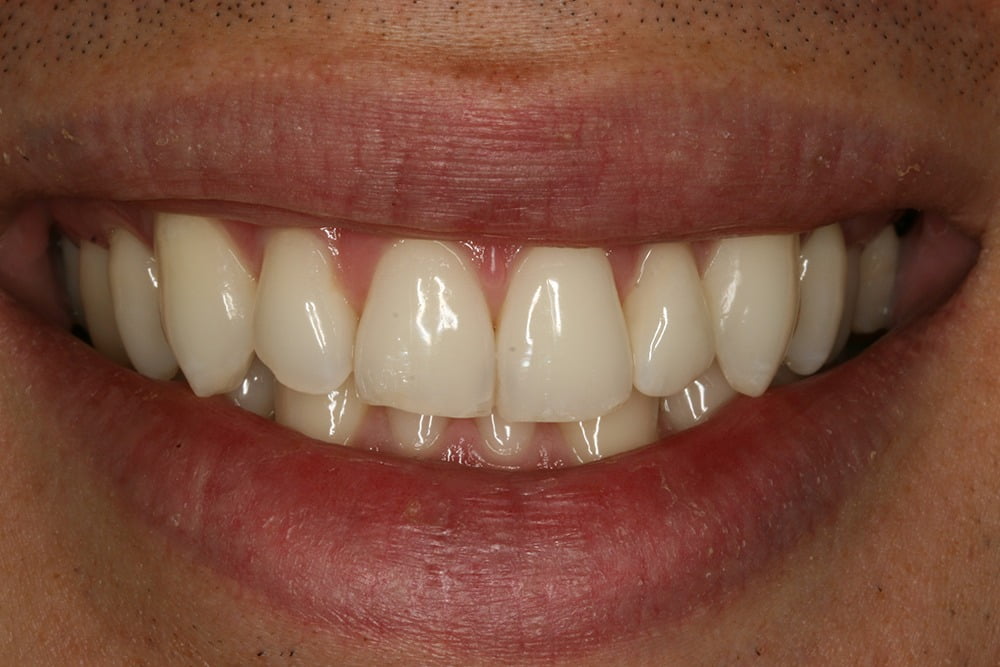 Crooked teeth veneers before and after