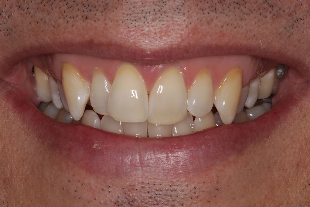 Patient Gallery &#8211; Invisalign