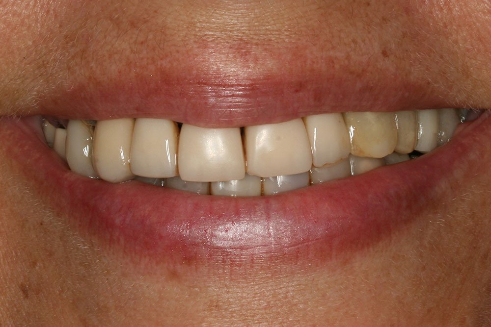 Patient Gallery &#8211; Dental Implants