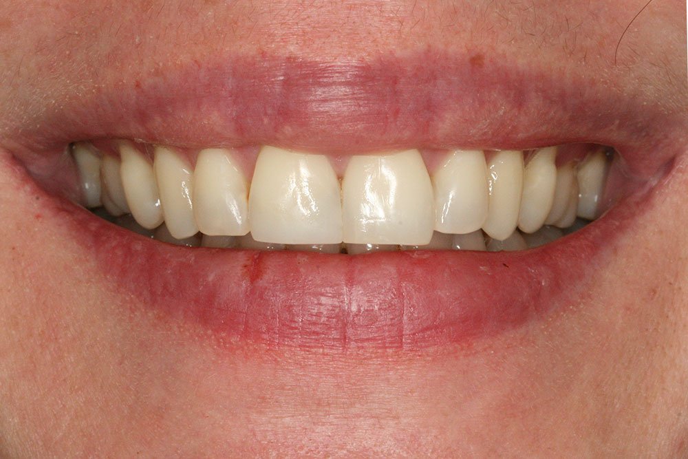 Patient Gallery &#8211; Composite Bonding