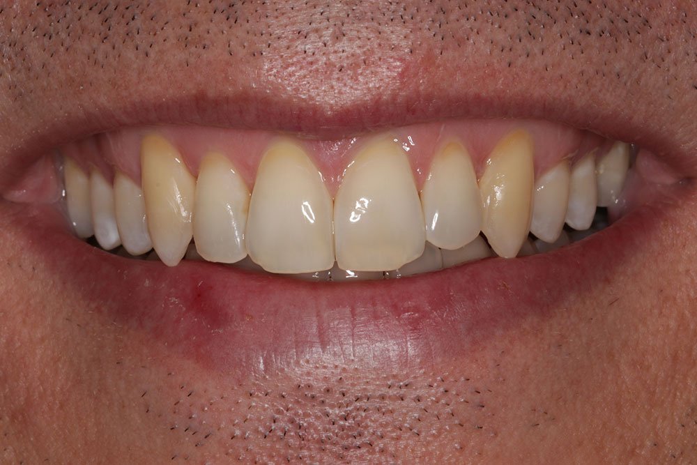 Patient Gallery &#8211; Invisalign