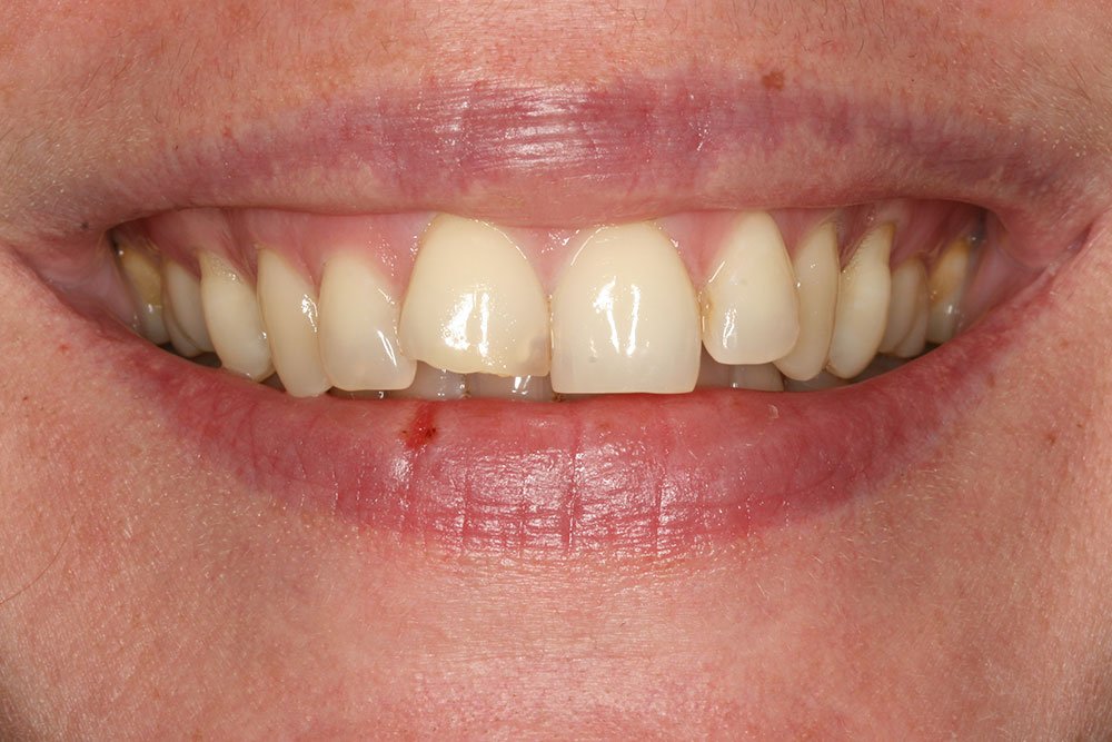 Patient Gallery &#8211; Composite Bonding