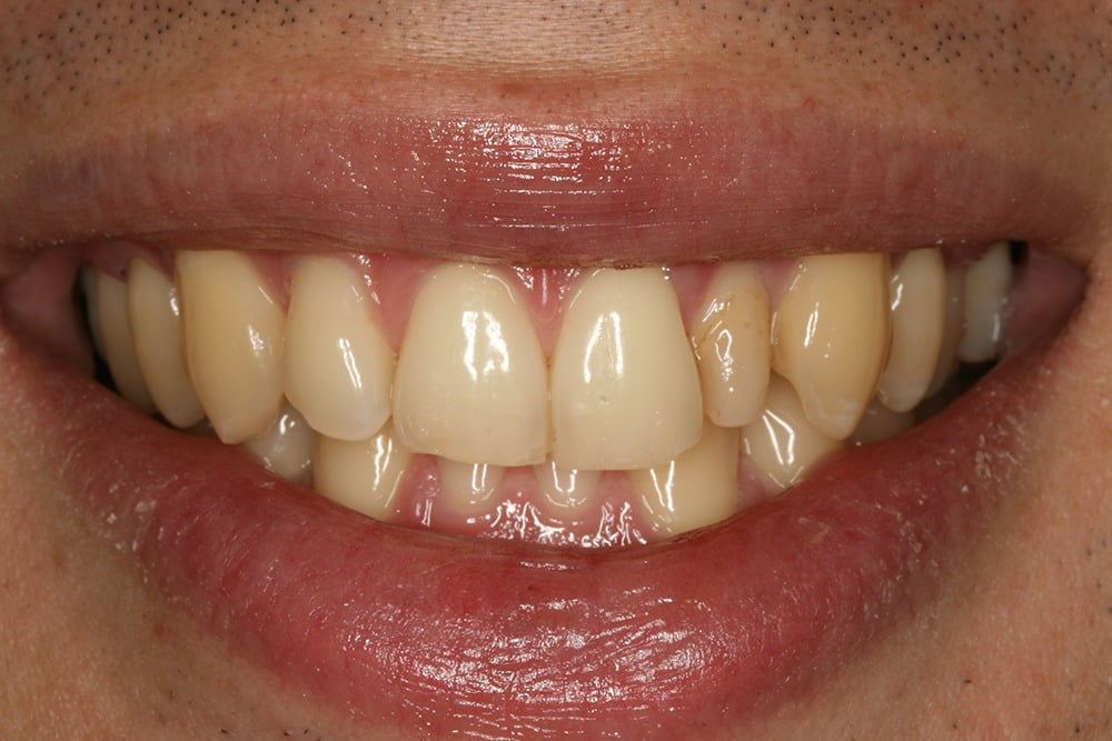 Crooked teeth veneers before and after