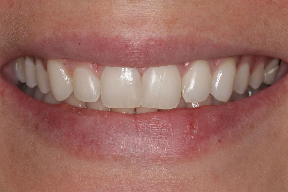 Patient Gallery &#8211; Composite Bonding