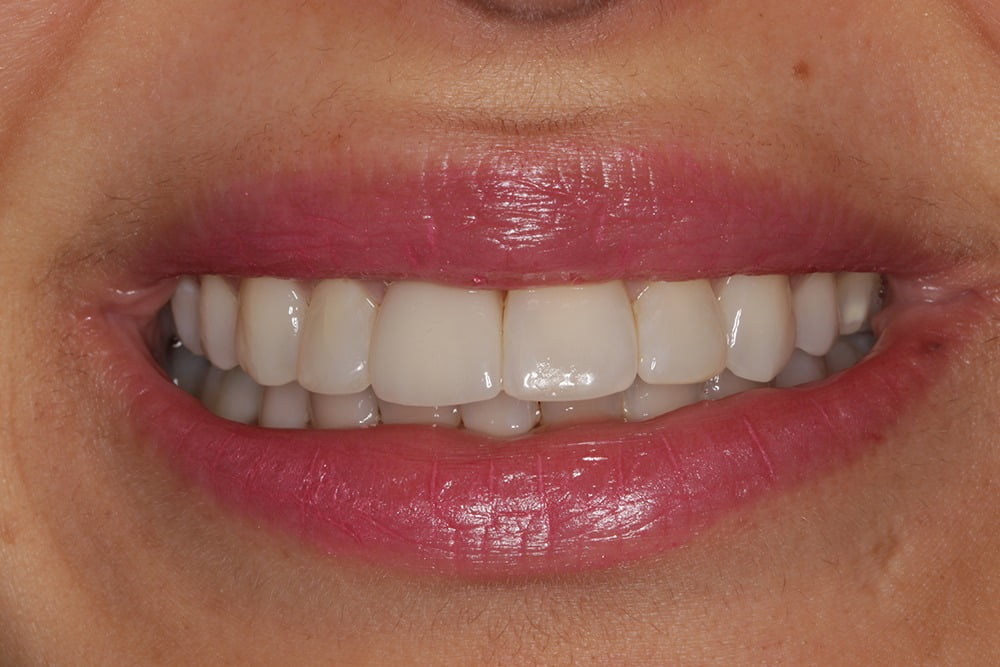 Crooked teeth veneers before and after