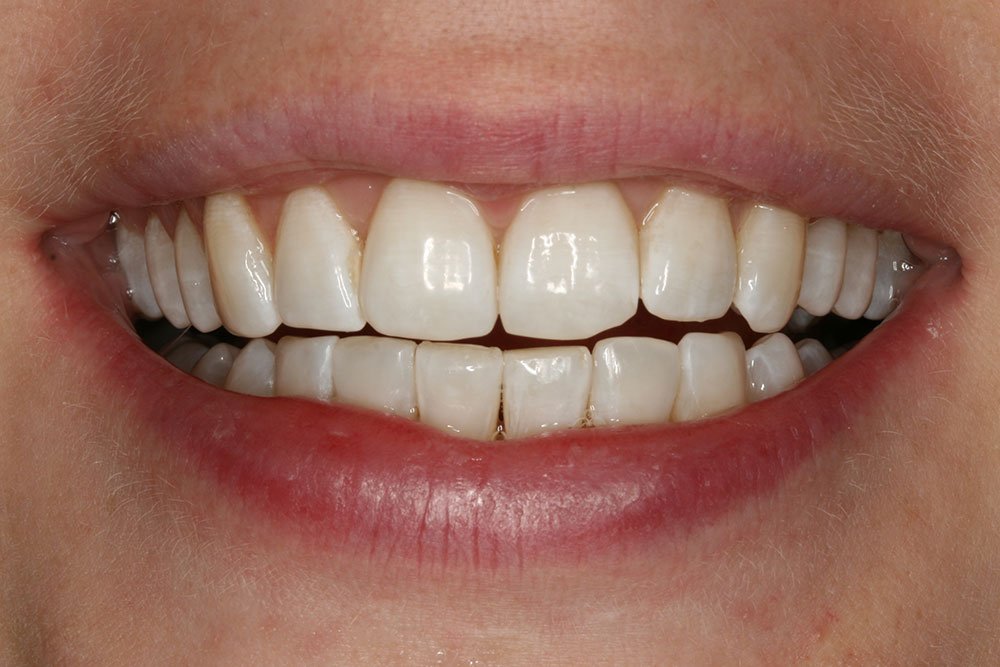 Patient Gallery &#8211; Invisalign