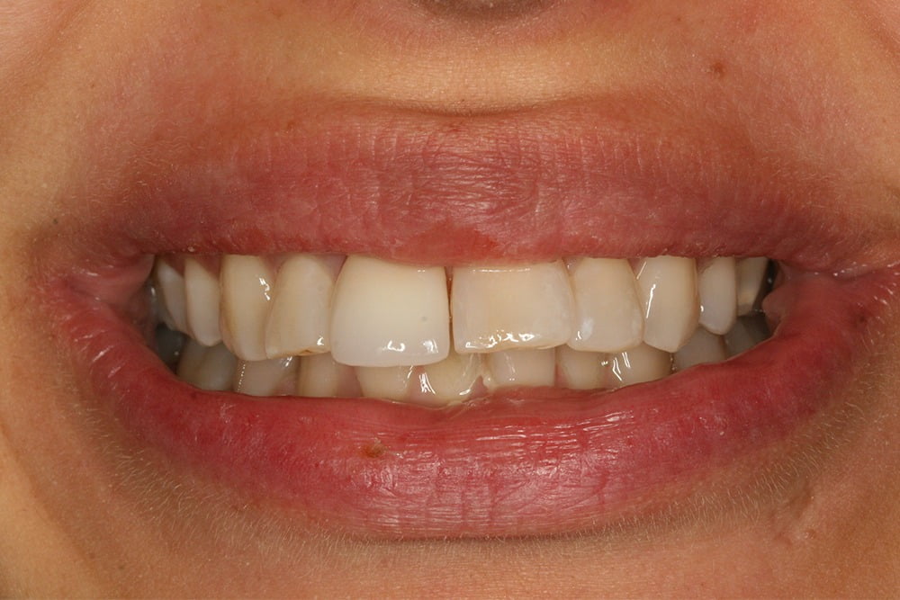 Crooked teeth veneers before and after